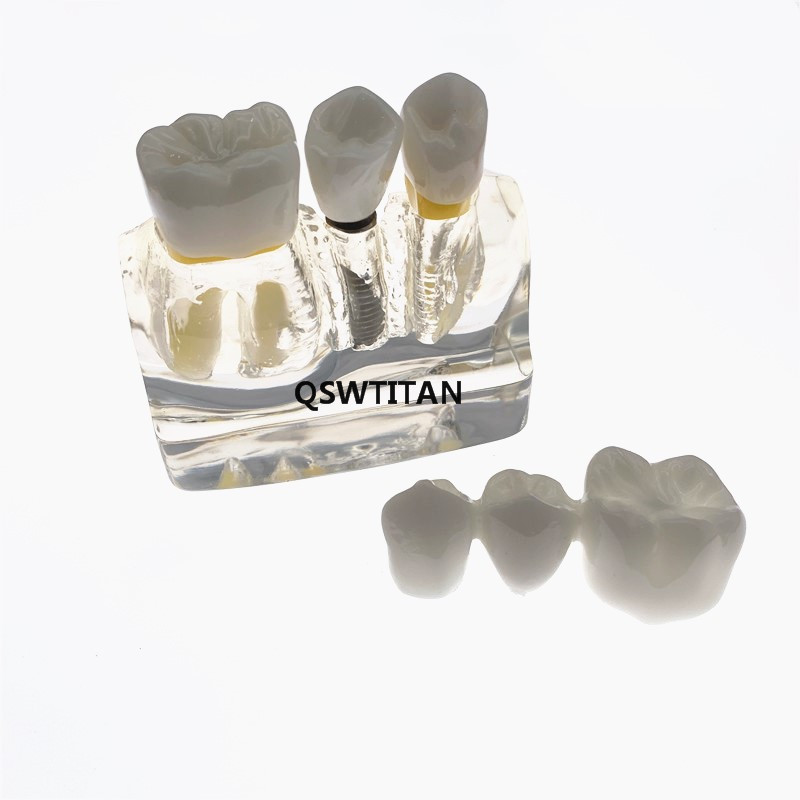 Clear Dental Demonstration Study Teeth Model for Implant Analysis Crown Bridge Model