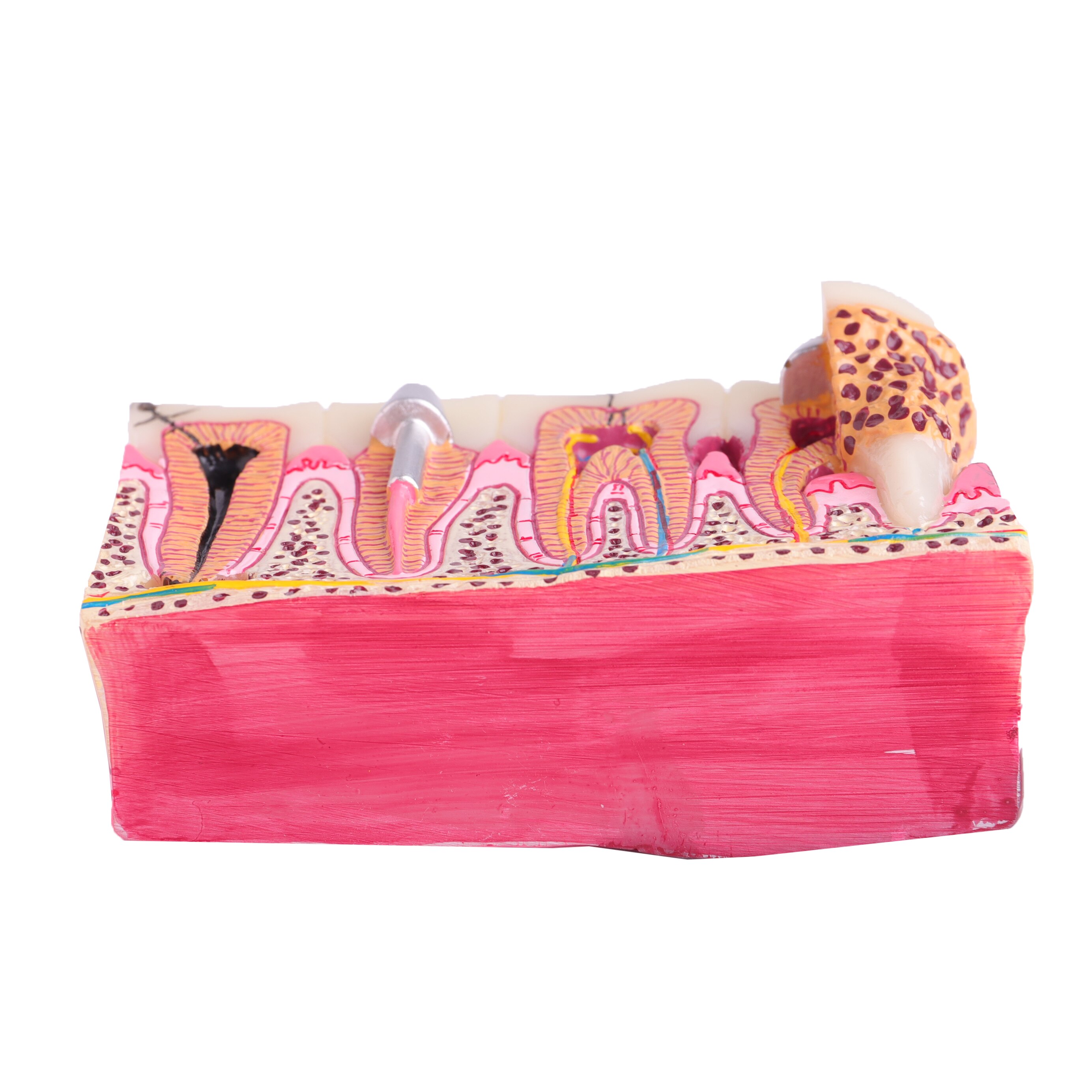 Dental Anatomy of Dental Caries Teeth Model Demonstration M4029 Planting Pathological Display Model