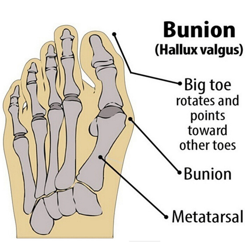 Zehenspreizer Hallux Valgus Ballen Korrektor Orthesen Füße Knochen Daumenversteller Korrektur Pedikübetreffend Sockenglätter