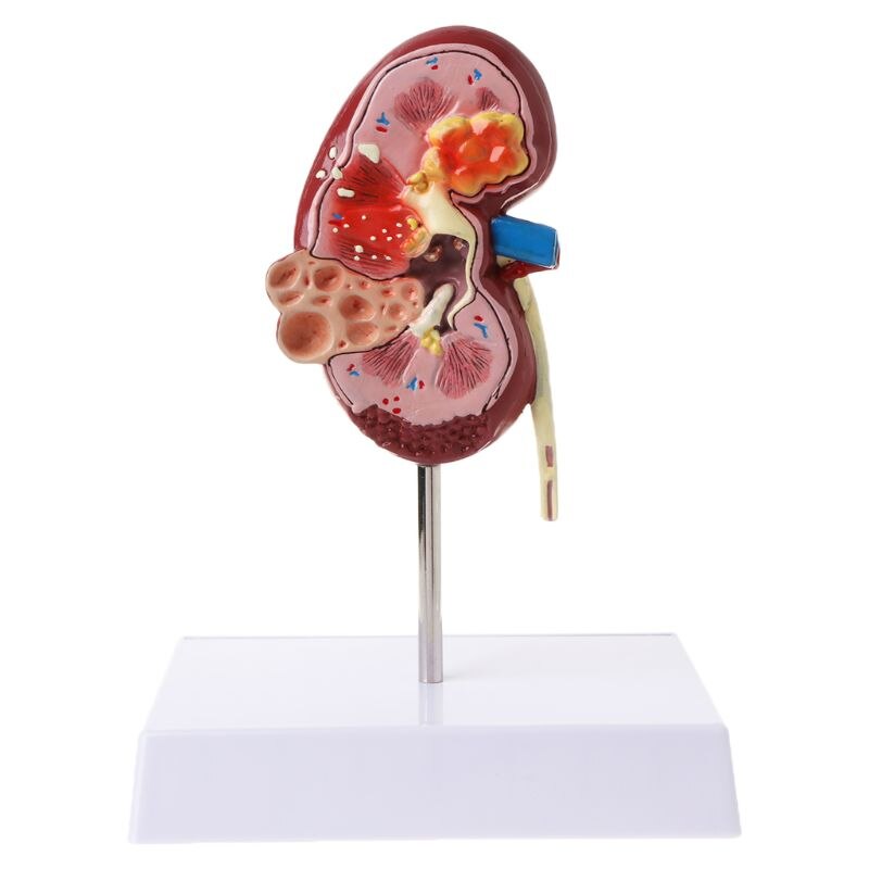 Life Size Human Kidney Diseased Model Anatomical Anatomy Diseased Pathological Stone Organ Teaching Supplies D5QC
