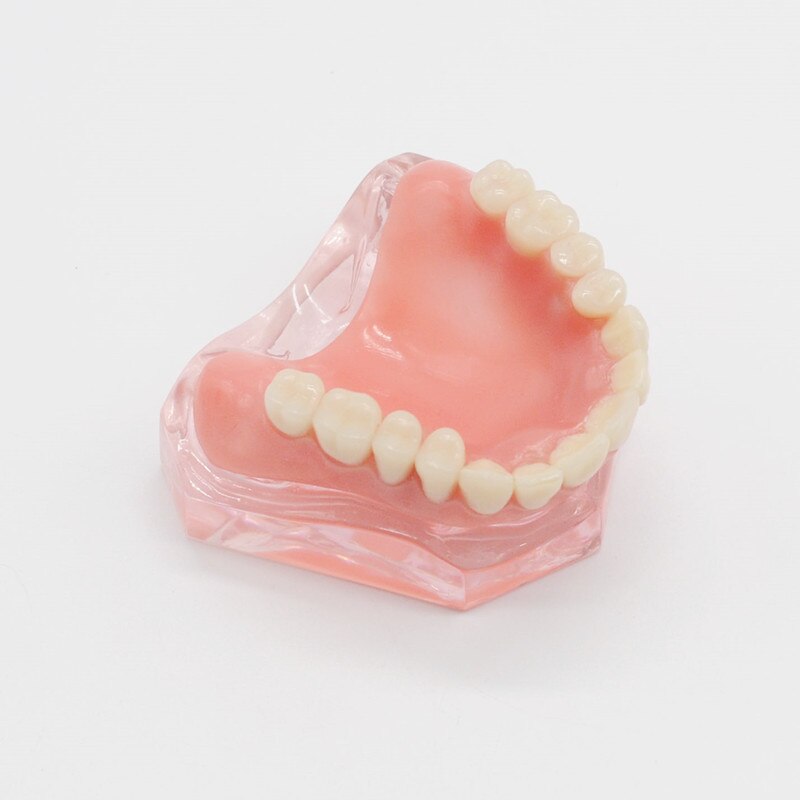 Zahn Zähne Modell Overdenture Oberen Vorderseite Oberkieferzähne 4 Implantate Restaurierung Zahnarzt Artikel Zahnersatz Zahn Extraktion