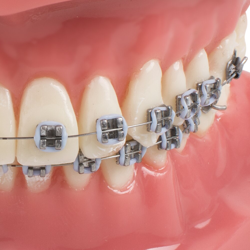 Dental Tanden Studie Orthodontische Rode Model met Metalen en Keramische Brackets Orale Demonstreren Modellen