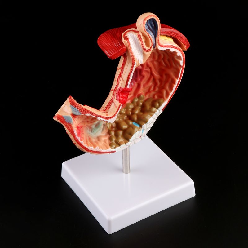 Human Anatomical Anatomy Stomach Model Gastric Pathology Gastritis Ulcer Teaching Learning Tool U4LD