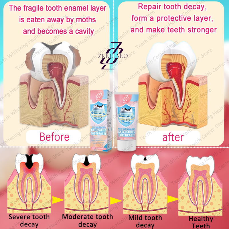 Latest Teeth Cleaning to Eliminate Tooth Decay