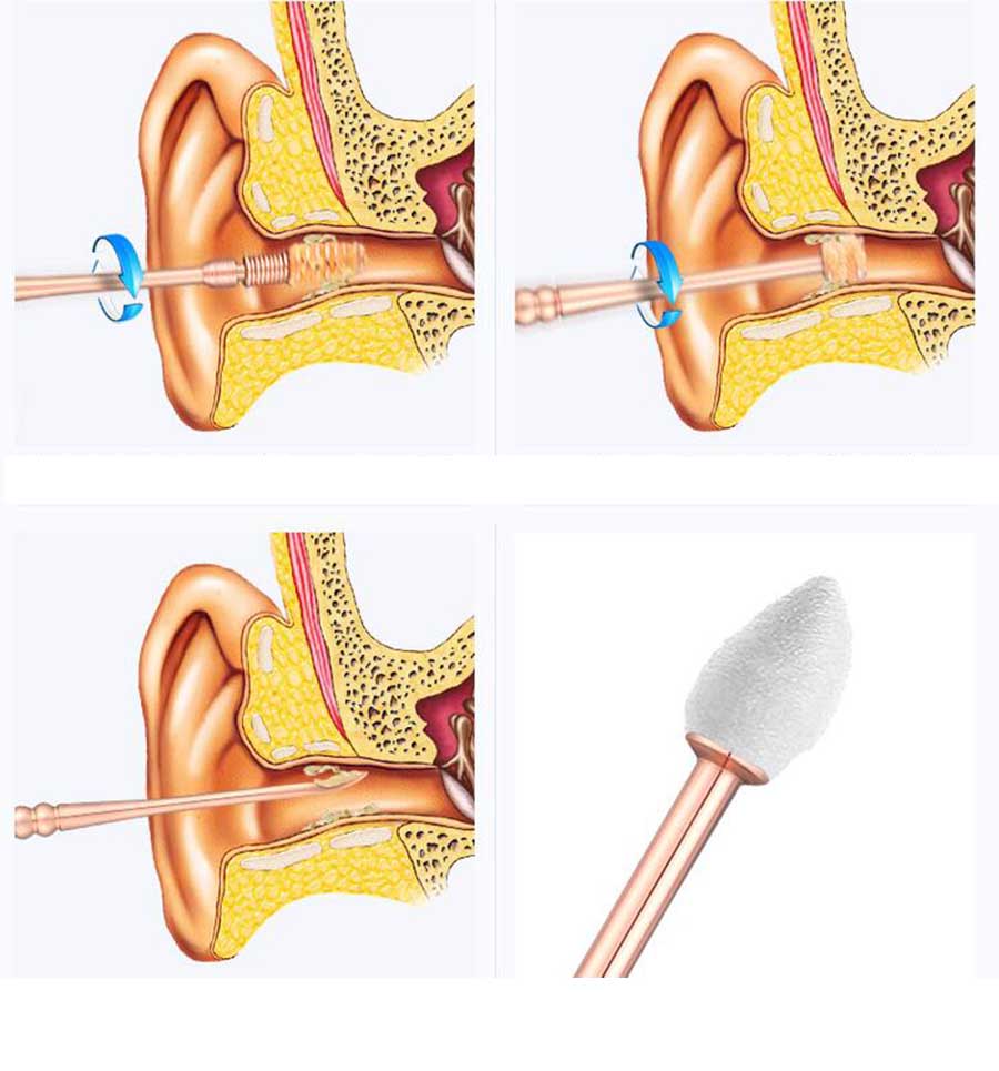 HANRIVER Graven oorsmeer lepel graven oor apparaat nemen oor kit pick knop oorsmeer pincet