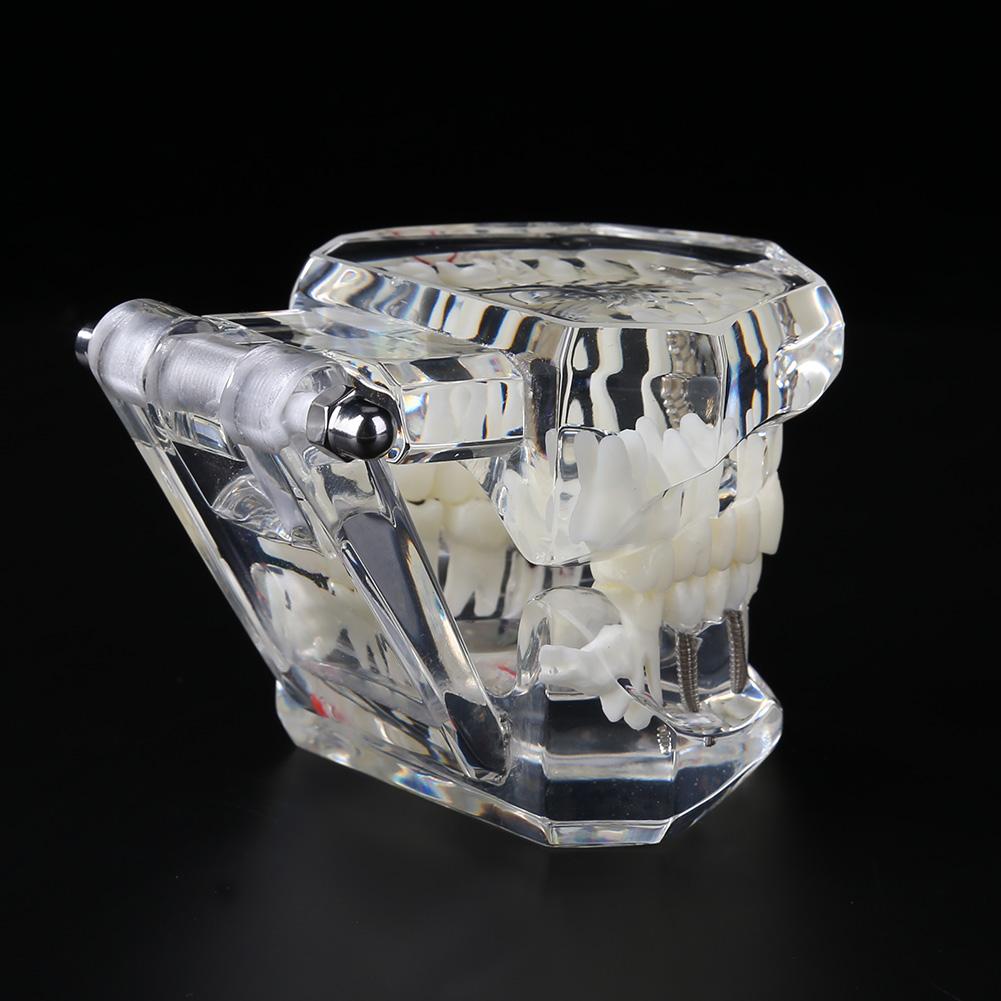 Dental Implant Ziekte Tanden Model Met Restauratie Brug Tand Tandarts Voor Medische Wetenschap Tandheelkundige Ziekte Onderwijs Studie