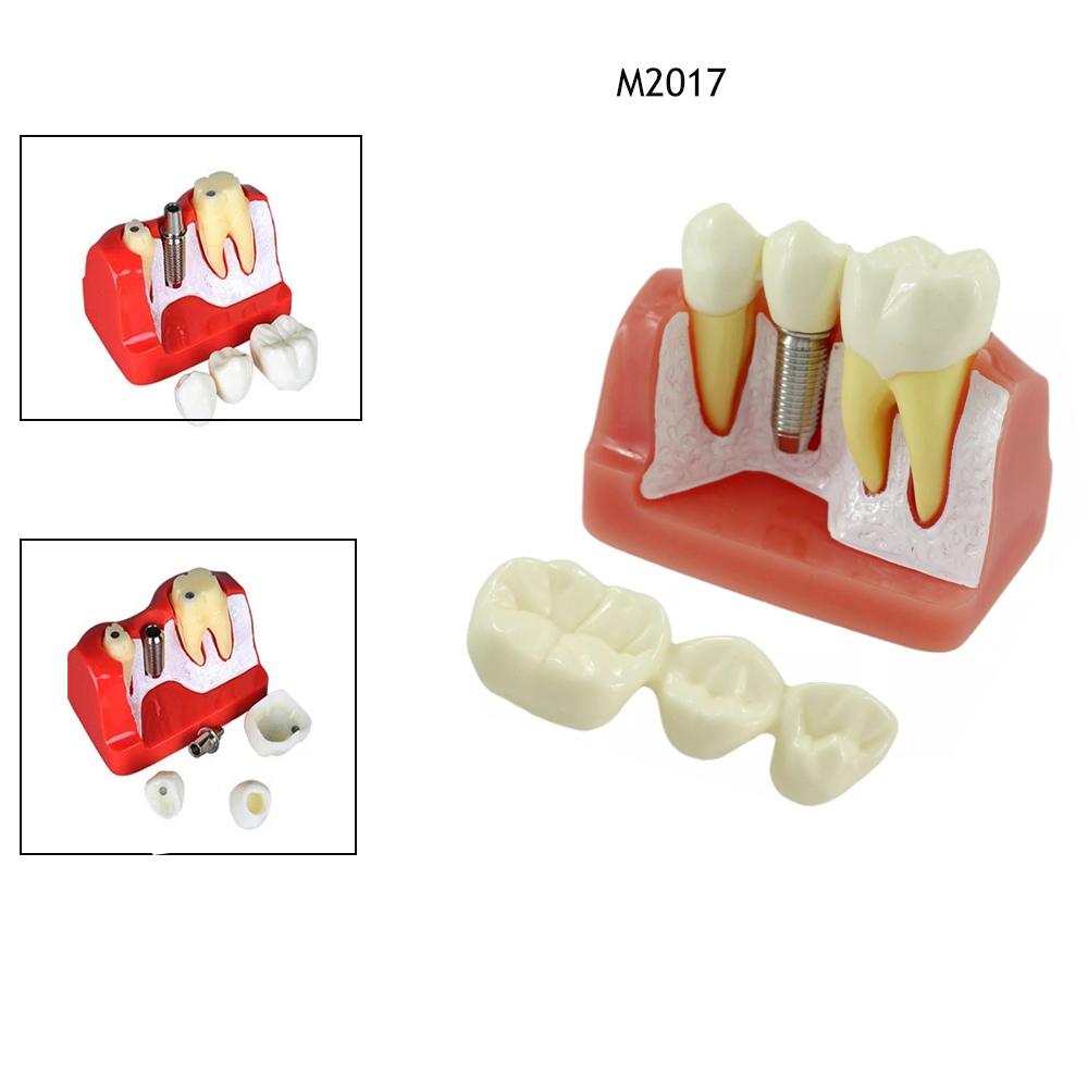 1Pcs Dental Tooth Implant Removable Model Crown Abutment Dentistry Laboratory Educational Materials Dentist Study Dentures M2017