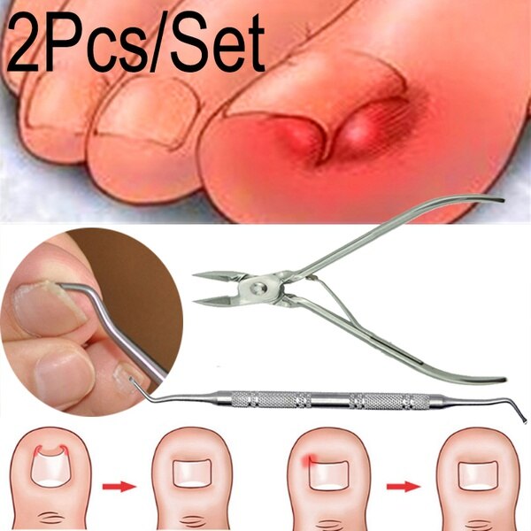 Ingrown Toenails Pedicure Foot Care Tool Nail Correction Clipper Cutters For Orthotic Acronyx Dead Skin Remover Podiatry: 2pcs set A