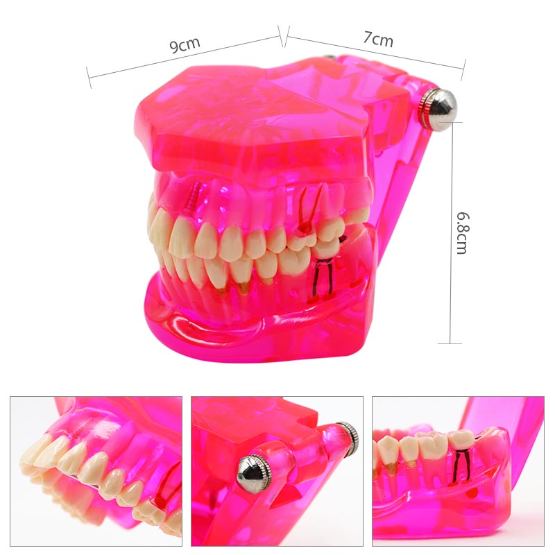 Modelo de dientes de estudio Dental desmontable para adultos, modelo de dientes de enseñanza patológica, rojo transparente, 1 unidad