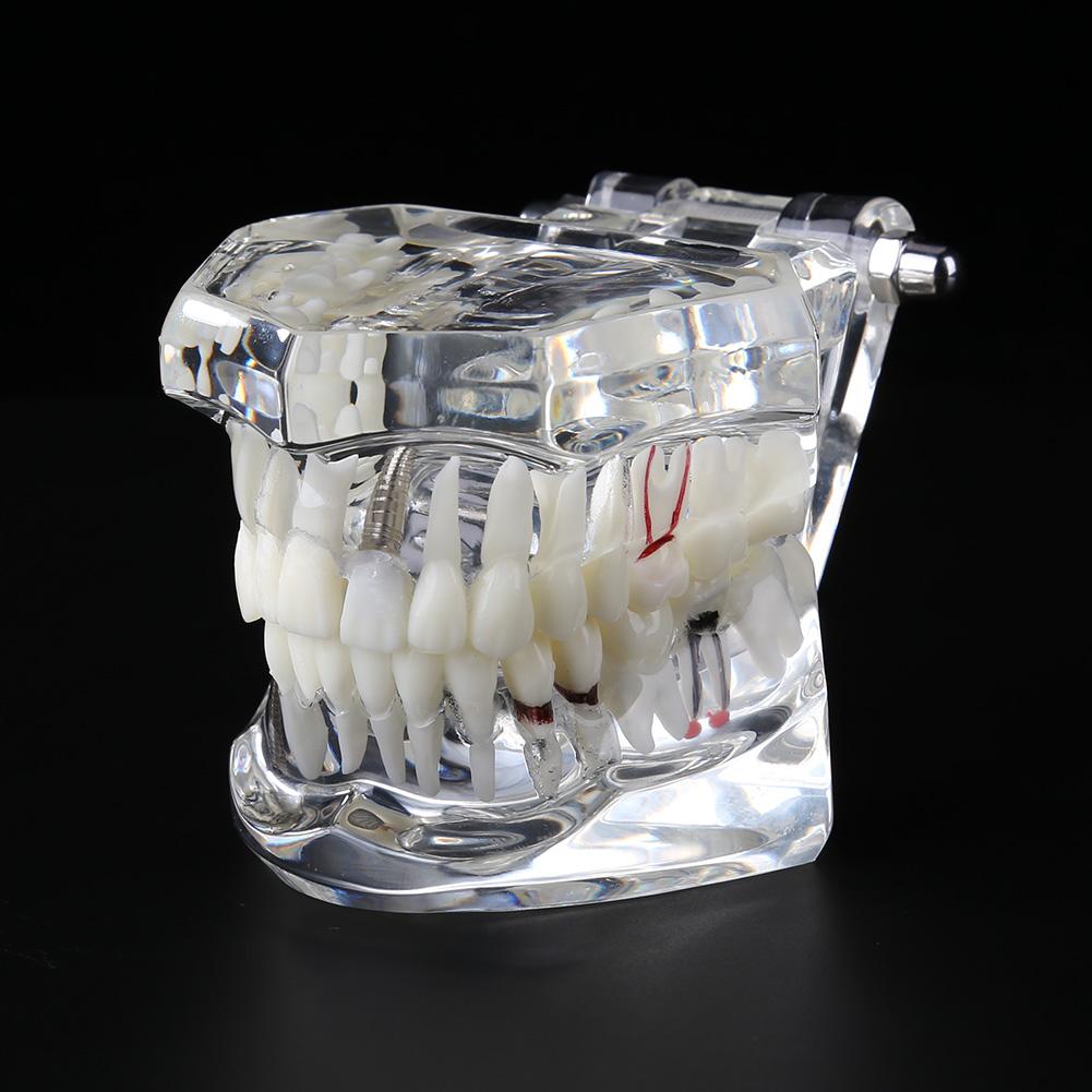 Dental Implant Ziekte Tanden Model Met Restauratie Brug Tand Tandarts Voor Medische Wetenschap Tandheelkundige Ziekte Onderwijs Studie