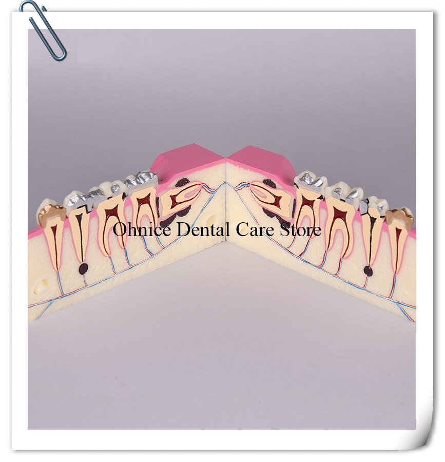 Periodontal disease teeth model M4009/dental teaching model Molar cross section study teeth model