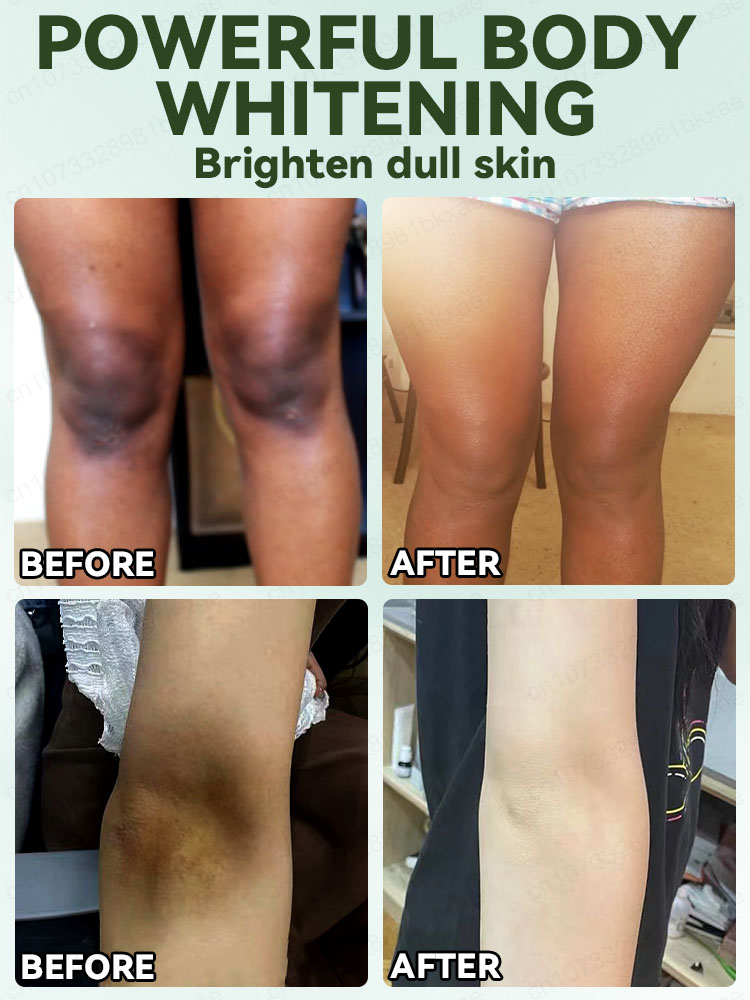 zie vaarwel tegen melanine