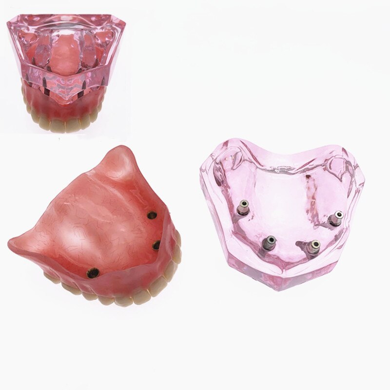 Sobredentadura Dental Superior con 4 implantes, modelo de demostración, enseñanza Dental, estudio, modelo de dientes