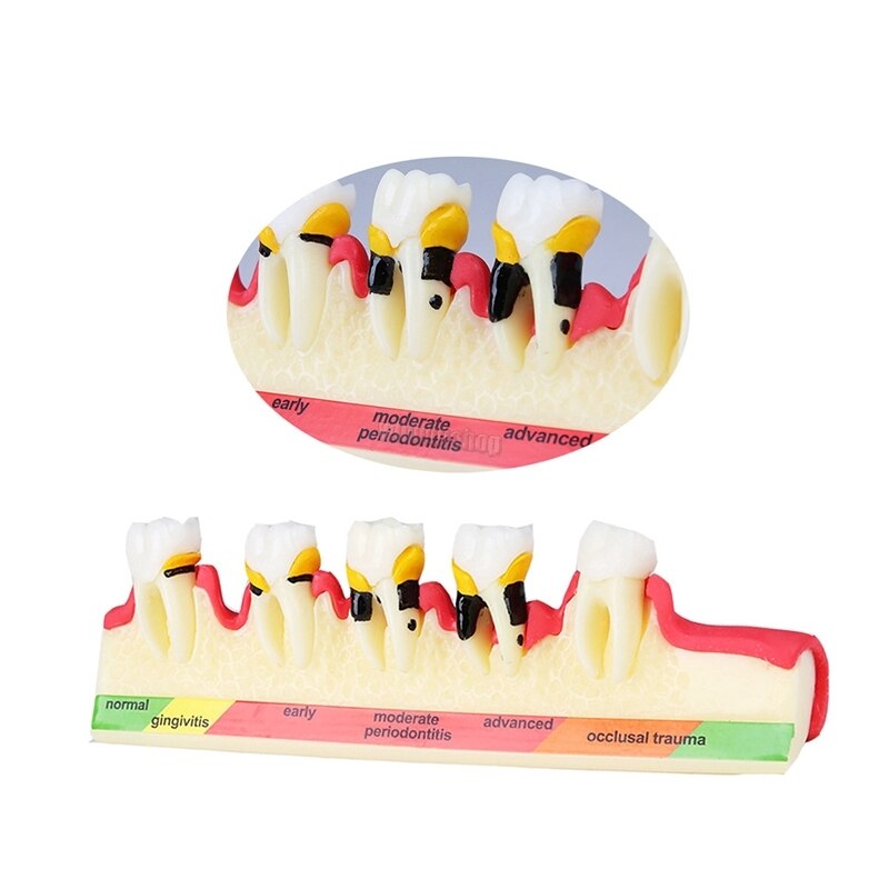 Dental Periodontal Disease Classification Model Demonstration Teach Study Decayed tooth Show Periodontal Disease Progress Model