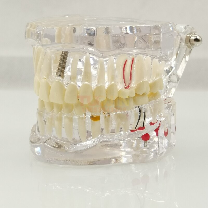 Dental Harz Zähne Tipodont Modell Für Dental Techniker Praxis Lehre Gum Zähne Kiefer Modell Zahnmedizin Ausrüstung: TYPE 10