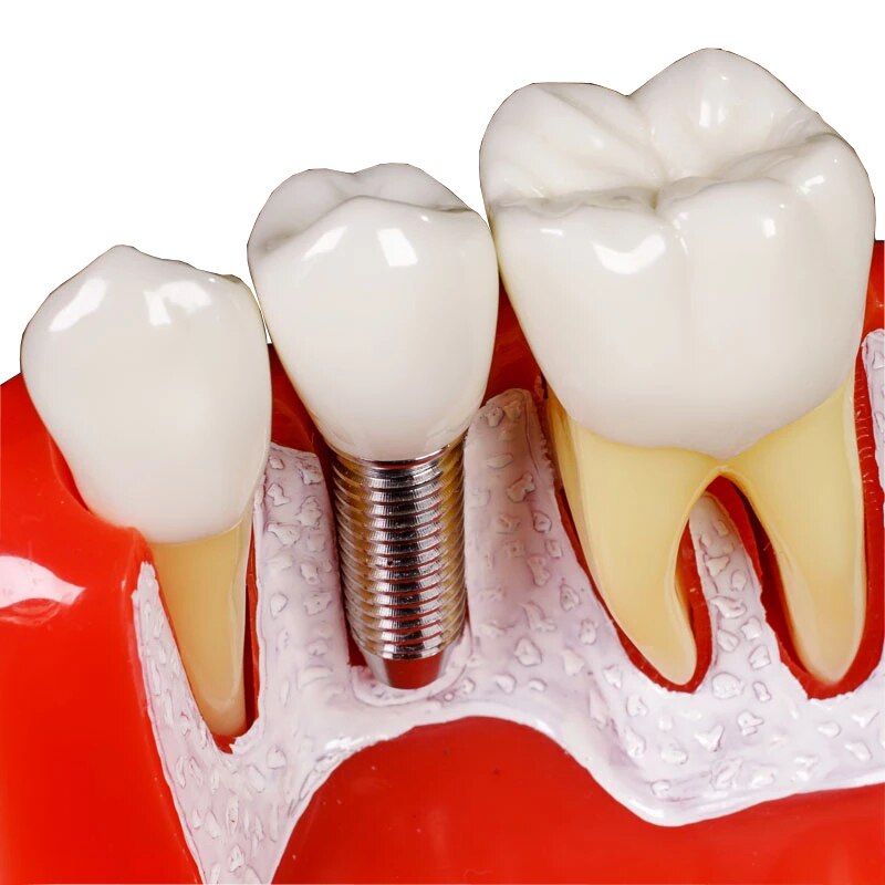 1Pcs Dental Tooth Implant Removable Model Crown Abutment Dentistry Laboratory Educational Materials Dentist Study Dentures M2017