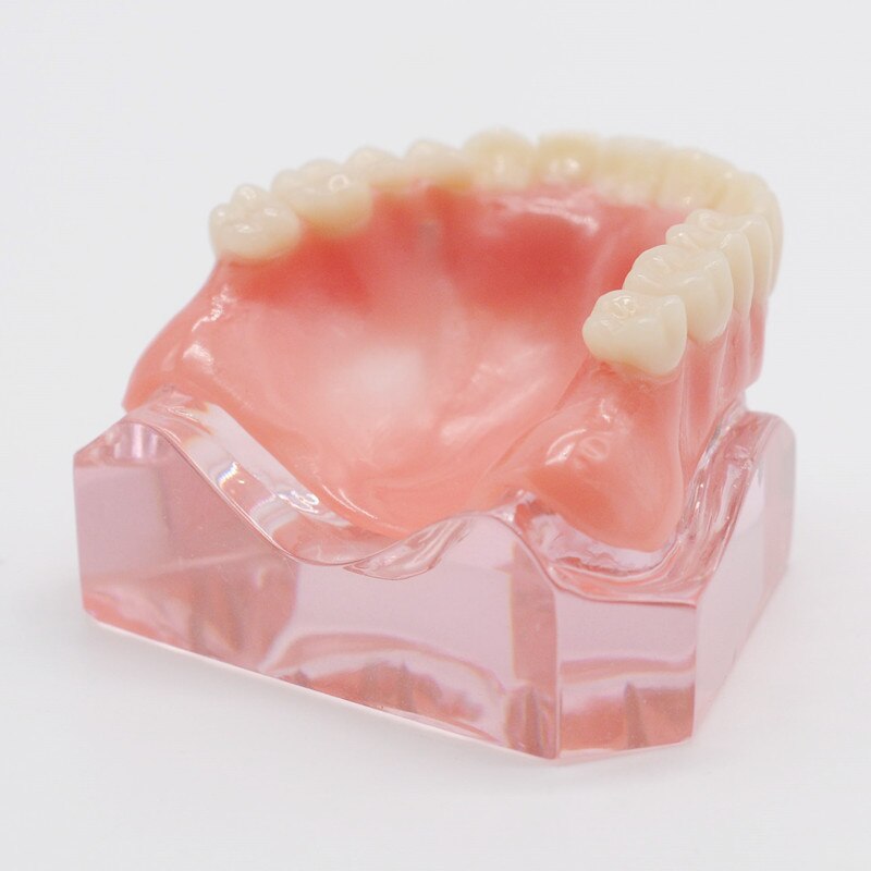 Zahn Zähne Modell Overdenture Oberen Vorderseite Oberkieferzähne 4 Implantate Restaurierung Zahnarzt Artikel Zahnersatz Zahn Extraktion