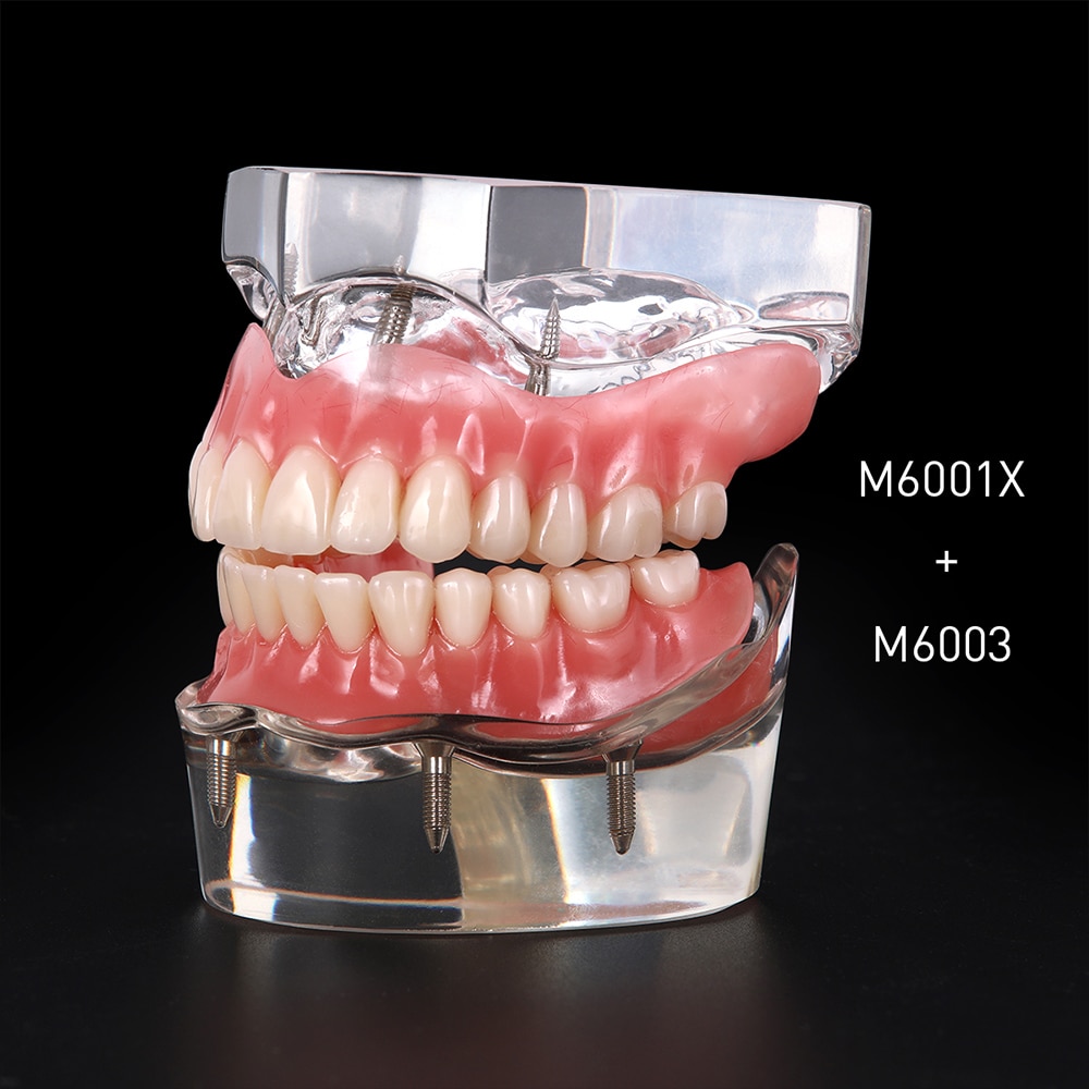 Tandimplantat restaurering tænder model aftagelig bro protese demo sygdom tænder model med restaurering bro undervisning undersøgelse