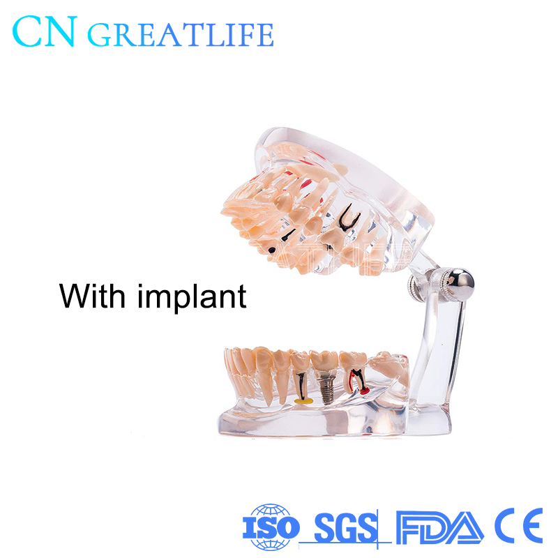 Good Typodont Teeth Model Practical False Dental Teeth Model Teeth Model for Studying: with implant