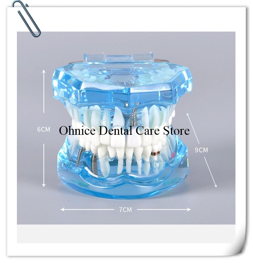 Dental Implantat Restaurierung zähne Modell M2001 Dental lehre zahn modell/Dental Labor Klinik zähne modell