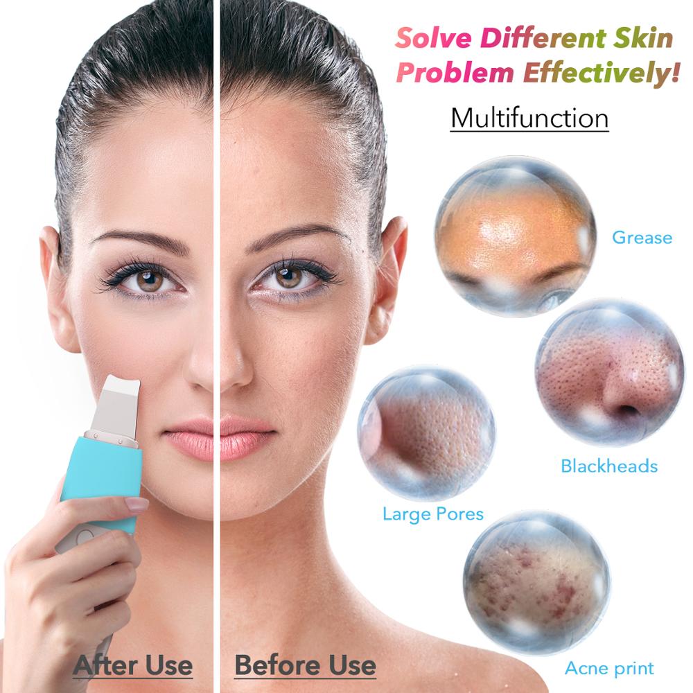 Limpiador ultrasónico de iones para piel, eliminador de espinillas, Extractor de poros, vibración de Peeling, herramienta de elevación Facial con carga USB