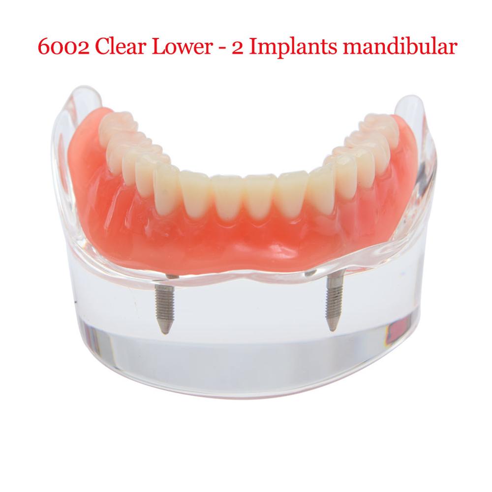 Dental Implant Teeth Teaching Model Overdenture Restoration Clear Removable Interior Maxillary Mandibular Tooth Demonstration: 6002  Lower 2