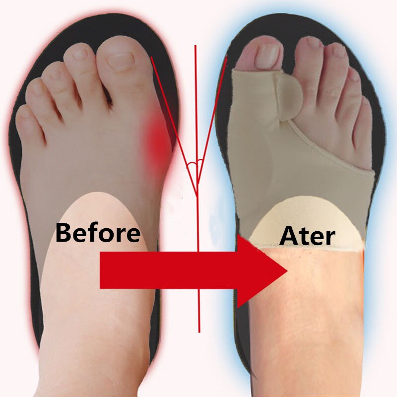 Silicone Toe Separator Splint Bunion Corrector for Bent Toes Overlapping Toes Hallux Valgus Big Toe Outer Straightener