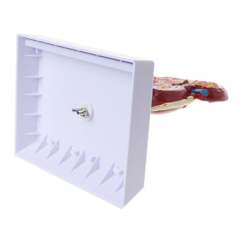 Life Size Human Kidney Diseased Model Anatomical Anatomy Diseased Pathological Stone Organ Teaching Supplies D5QC