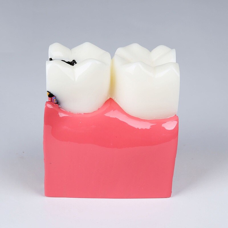 6Ttimes Cariës Comparation Tanden Model M4021 Tonen Normale Anatomische Oppervlak Van De Tand/Dental Onderwijs Model M4021