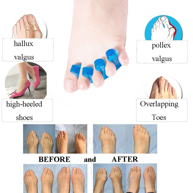 1Pair BYEPAIN Happy Toes Gel Toe Separators Stretchers and Straighteners for Foot Pain &amp; Bunion Relief, Hammer Toes and More