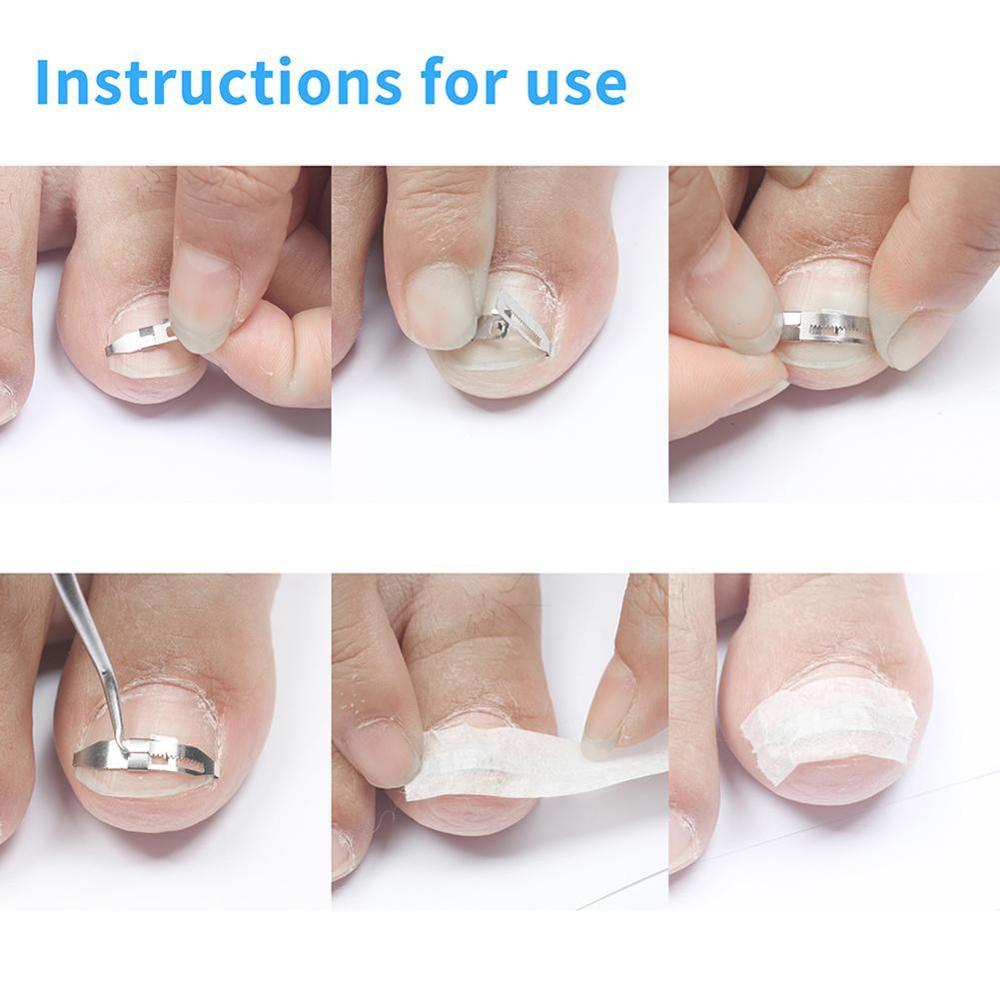 1 Set Ingrown Toe Nail Straightening Clip Wire Fix... Grandado