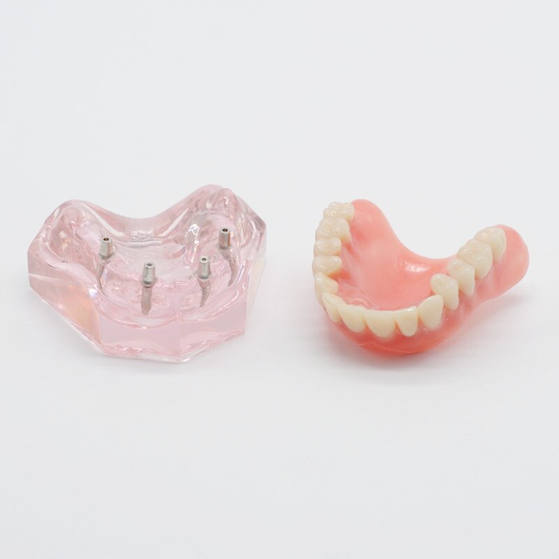 Zahn Zähne Modell Overdenture Oberen Vorderseite Oberkieferzähne 4 Implantate Restaurierung Zahnarzt Artikel Zahnersatz Zahn Extraktion