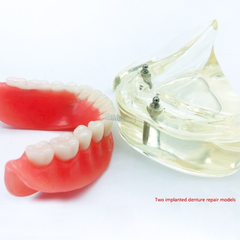 Two types of doctor-patient teaching models with explants for removable mandibular denture models