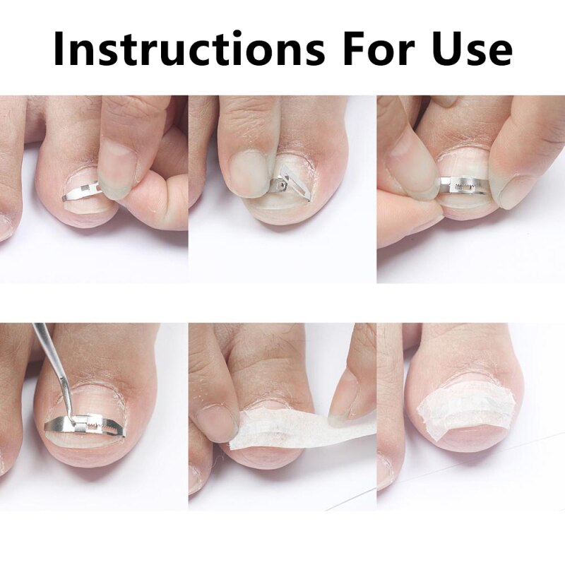 Ingrown Toe Nail Correction Tool Toenail Straightening Correctors Patch