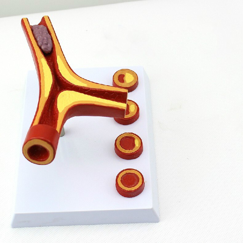 10X Enlarge Human Arterial Coronary Arteriosclerosis Atherosclerosis Coronary Model Cross Section Heart Disease Thrombus Model