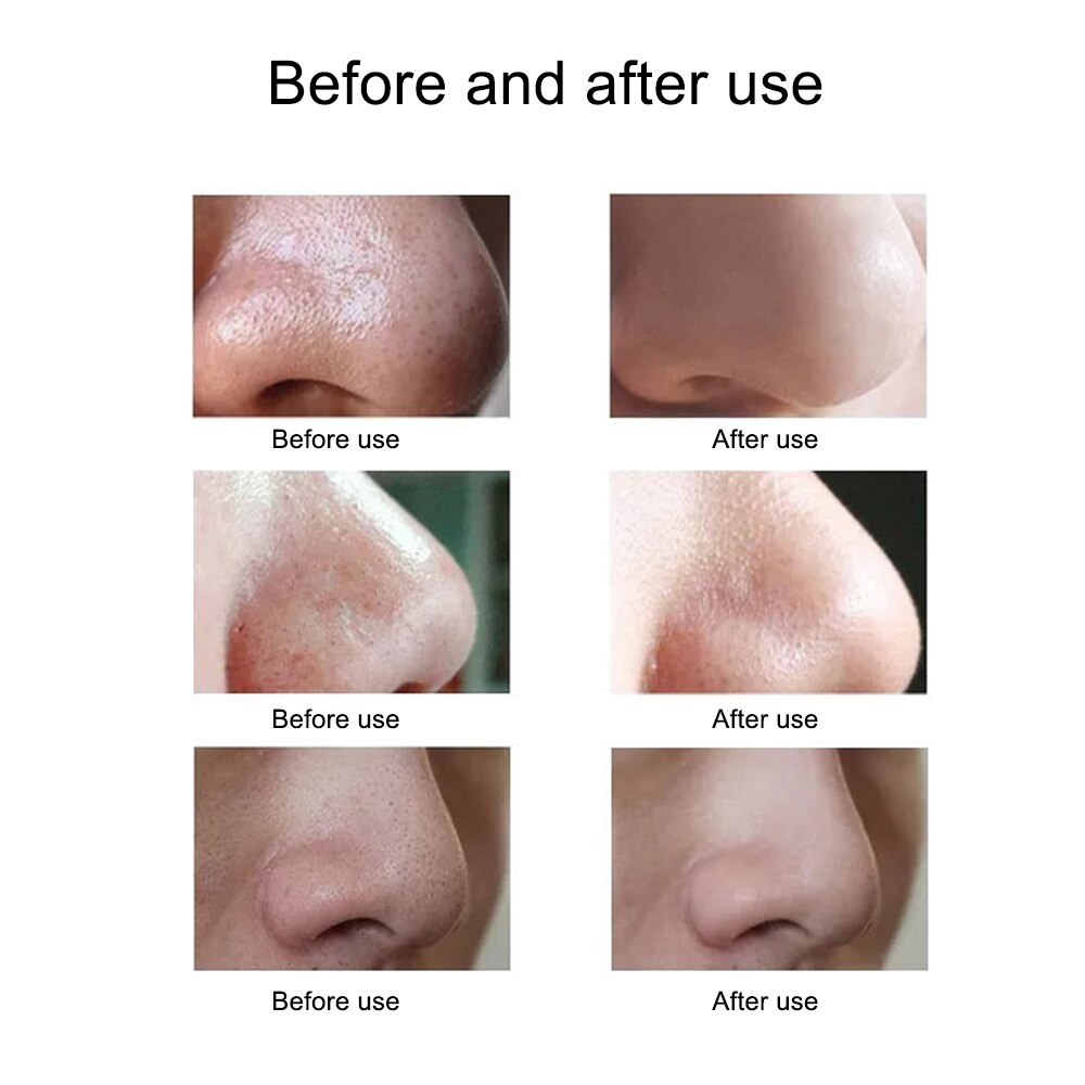 Electric Blackhead Suction Device with 5 in 1 Pimple Zit Comedone Extractor Tool Acne Removal Kit Blackhead Remover