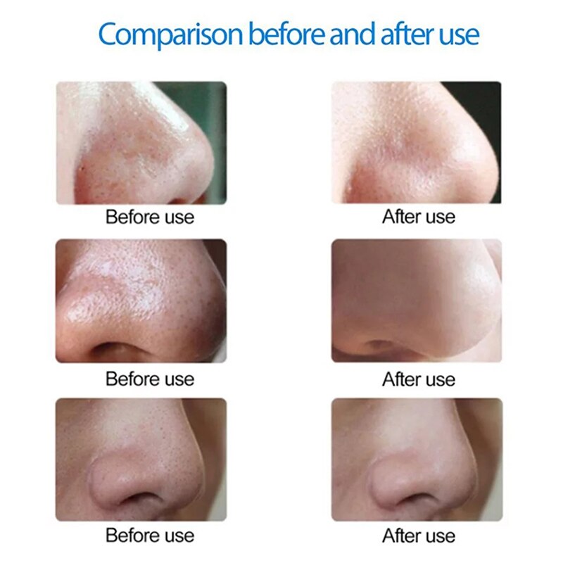 Mini Portable Blackhead Pore Remover Tool Face Cleanser Beauty Instrument Vacuum Extractor Acne Suction Skin Care SANA88