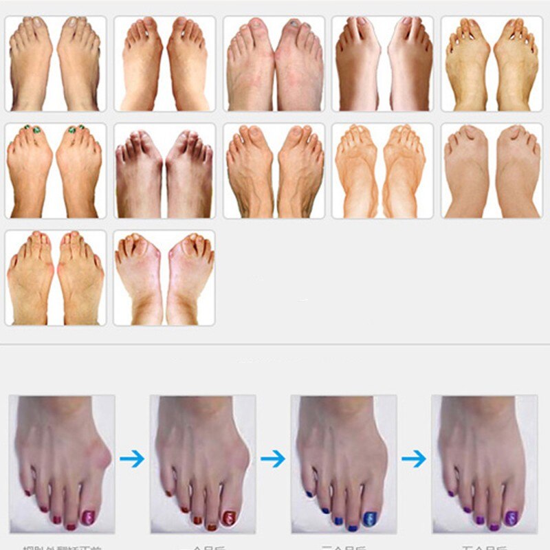 2 Paar Heißer Kleinen Daumen Silikon-Gel Zehe Ballen Schutz Pedikübetreffend Hallux Valgus Korrektur Kleinen Zeh Ring Separator Füße Fuß pflege