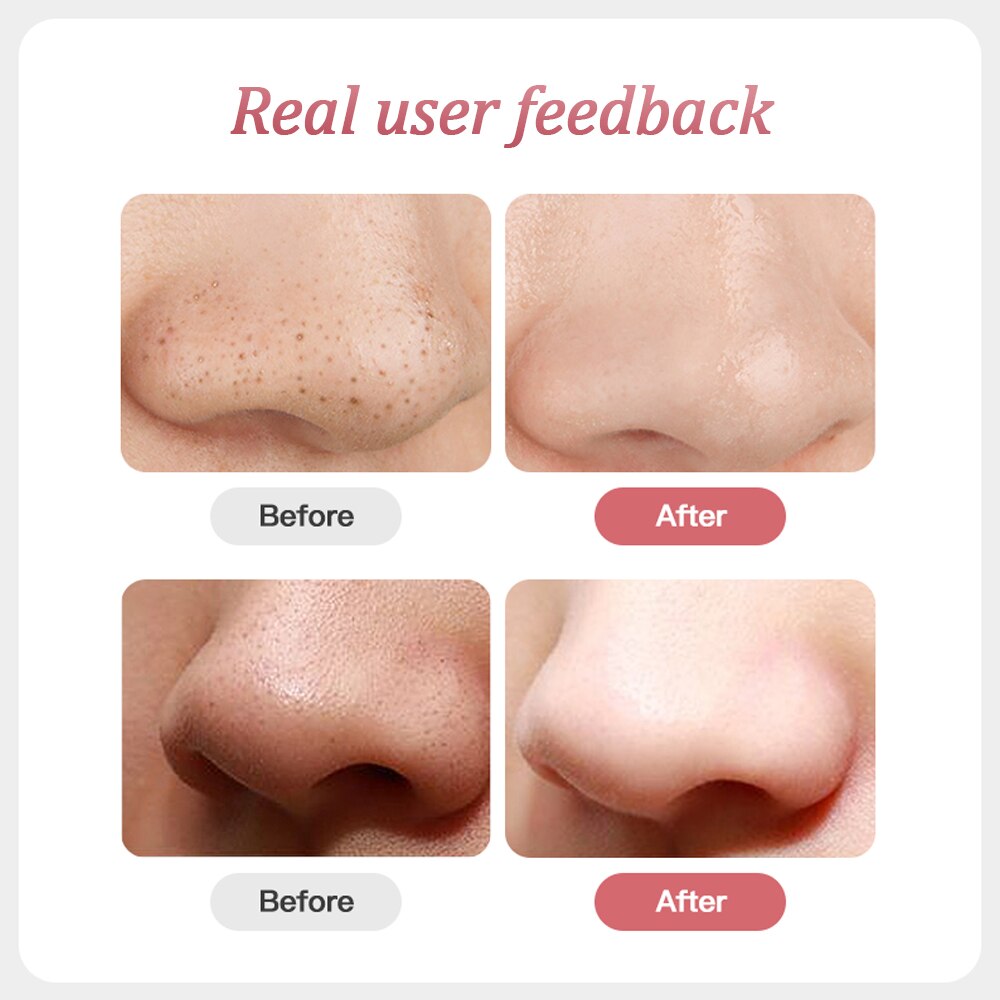 Electric Facial Pore Cleaner Exfoliator Face Blackhead Remover Acne Vacuum Deep Cleansing Suction Machine Nano Sprayer Steamer