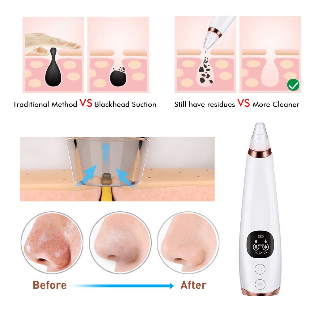 Microdermabrasion Blackhead Remover Vacuum Suction Face Pimple Acne Comedone Extractor Facial Pores Cleaner Skin Care Tools