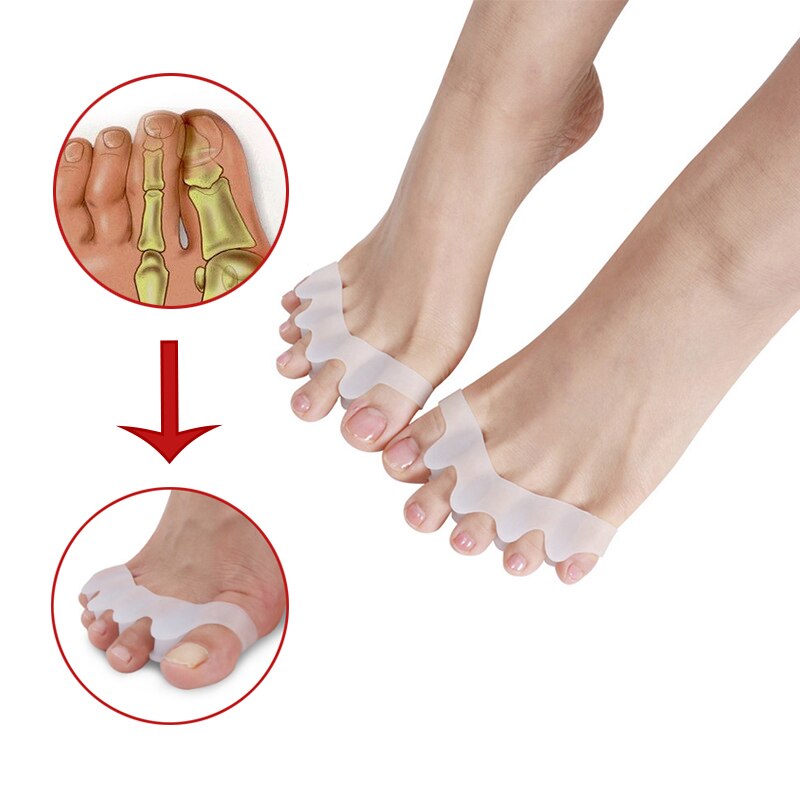 1 Paar/2 Stuks Siliconen Teen Separator Correctie Teen Protectiony Duim Valgus Orthese Voetverzorging Tool Straightener Strooier Haluksy