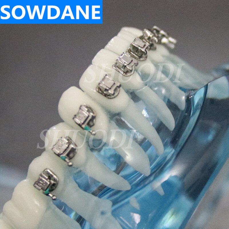 Dental Orthodontic Model with Ceramic and Self-Ligating Metal Brackets for Patient Communication