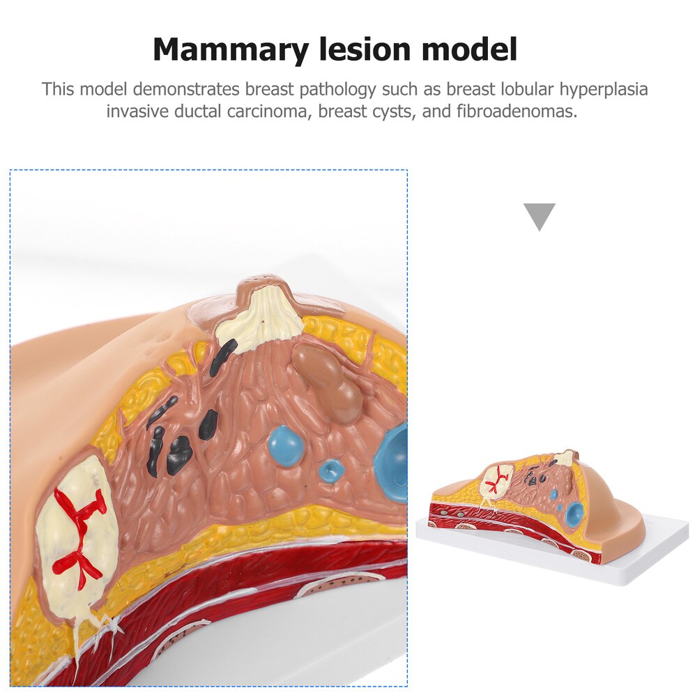 Female Breast Disease Pathology Model Udder Lesion Model Patient Communication