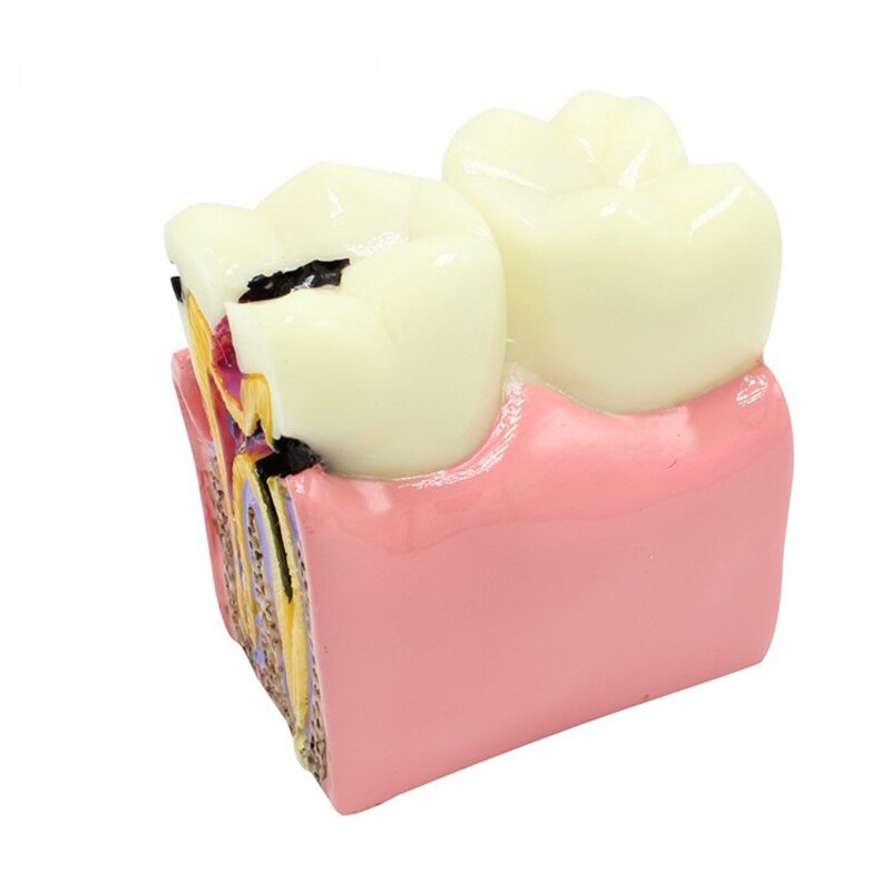 6Ttimes Cariës Comparation Tanden Model M4021 Tonen Normale Anatomische Oppervlak Van De Tand/Dental Onderwijs Model M4021