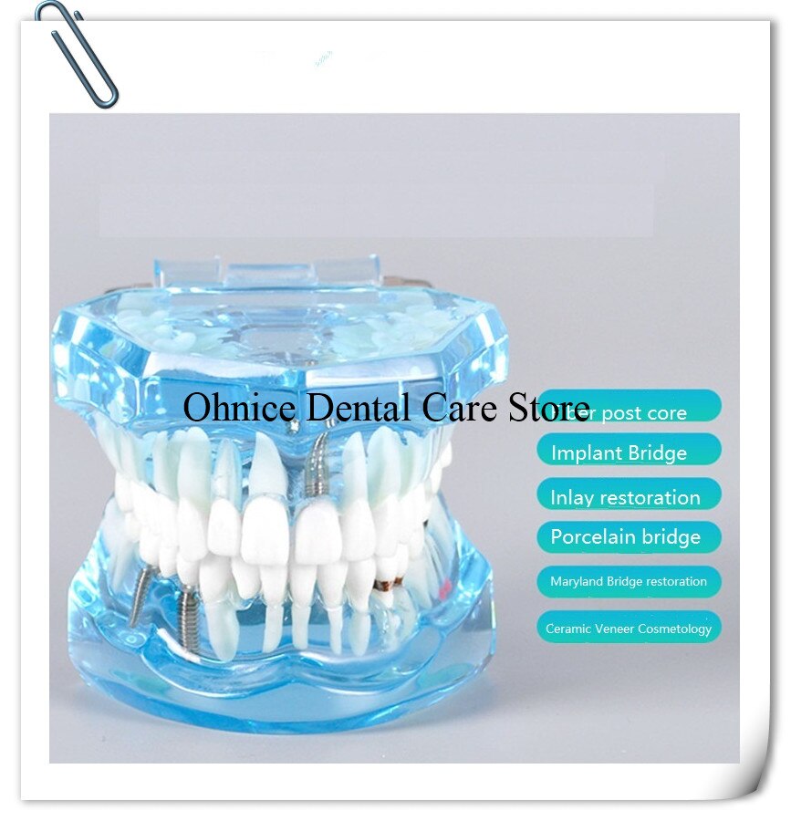 Dental Implantat Restaurierung zähne Modell M2001 Dental lehre zahn modell/Dental Labor Klinik zähne modell