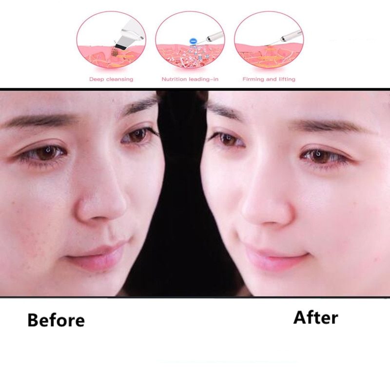 Skin Scrubber Facial Skin Scrubber Electric SPA Gentle Blackhead Remover Ultrasonic Facial Cleaner Spatula Face Lifting Massager