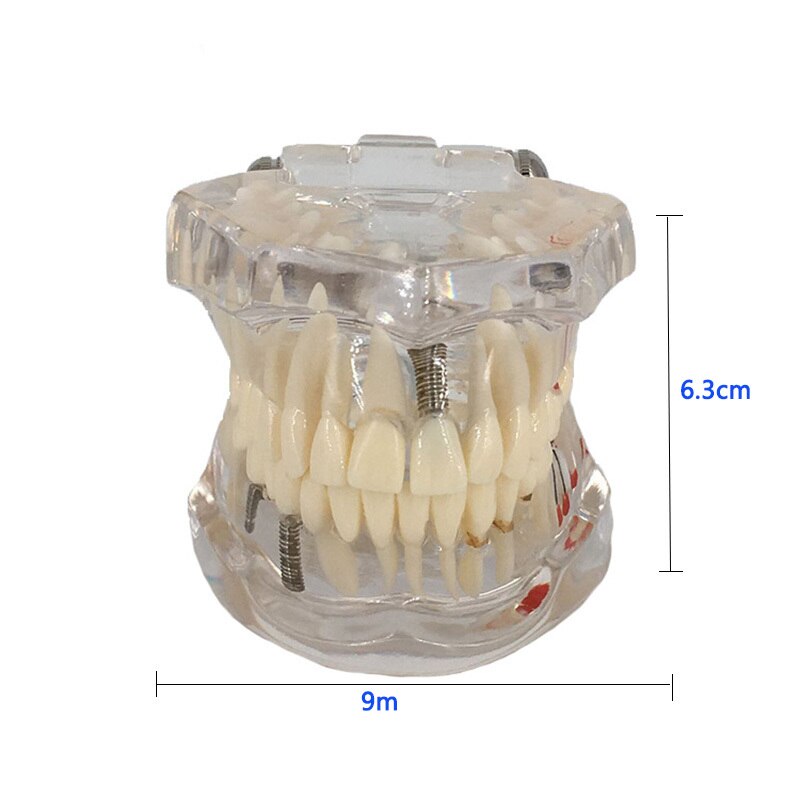 Tandheelkundige Restauratie Tanden Model Transparante Implant Disedental Implant Ziekte Tanden Model Met Restauratie Brug Tand Tandarts