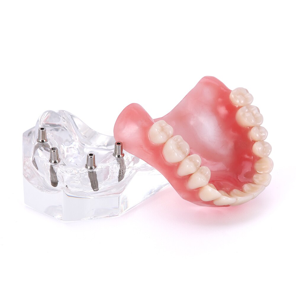 Dental Implant Teeth Model Removable Interior Mand... Grandado