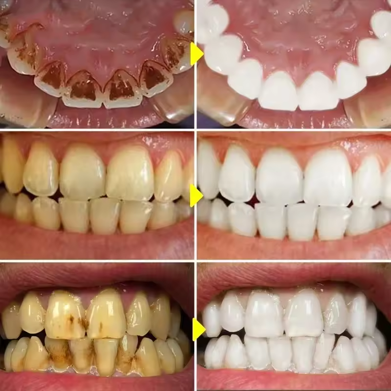 Teeth Whitening Toothpaste Fruit Acid Remove Calculus Plaque Stains Fresh Breath Cleaning Oral Hygiene Dental Bleach Care Tools