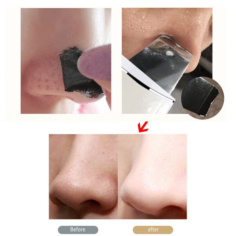 Limpiador ultrasónico de piel, limpieza por vibración, eliminación de poros, eliminación de suciedad, puntos negros, arrugas, masajeador Facial calmante, herramienta para pelar la piel